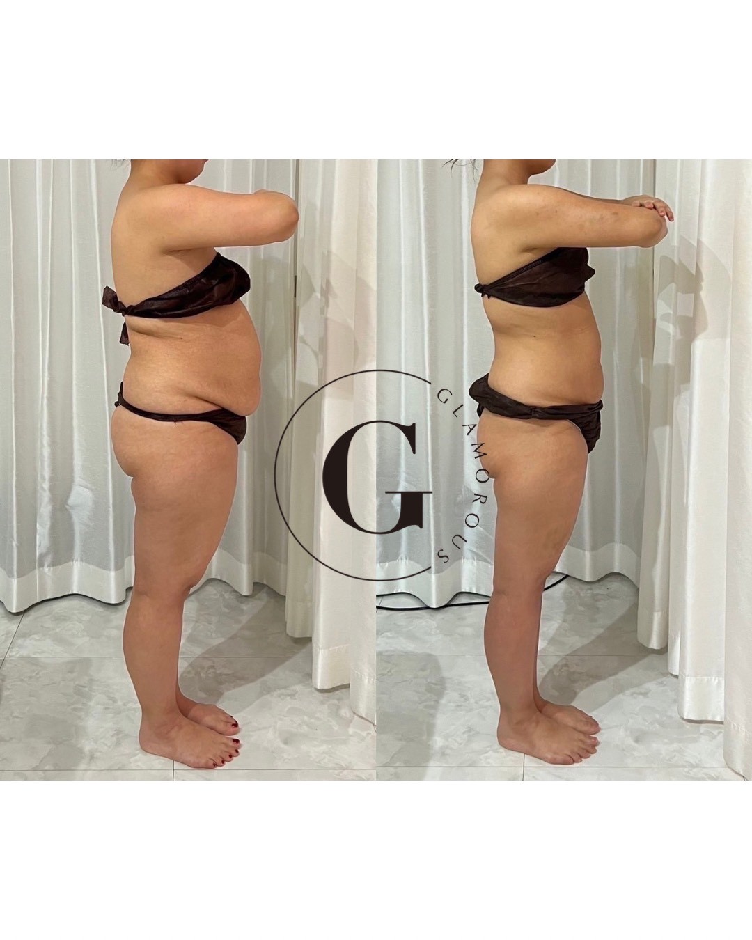 GLAMOROUSダイエット ビフォーアフター事例1